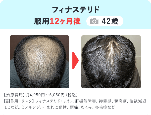 フィナ錠 服用12ヶ月後