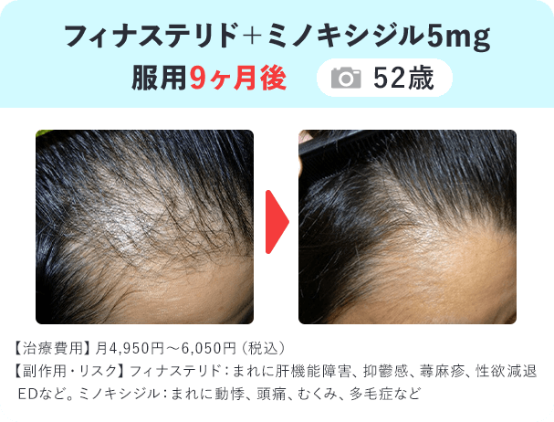 フィナ錠＋ミノキ錠5mg 服用9ヶ月後