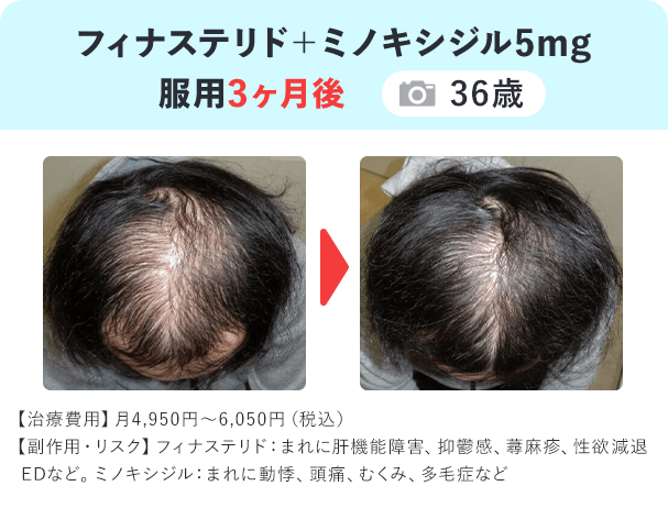 フィナ錠＋ミノキ錠5mg 服用3ヶ月後